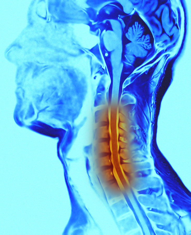 Fejfájás a nyaki osteochondrozist kezelő gyógyszerek miatt. Varikoosok ostechondrosis tünetei