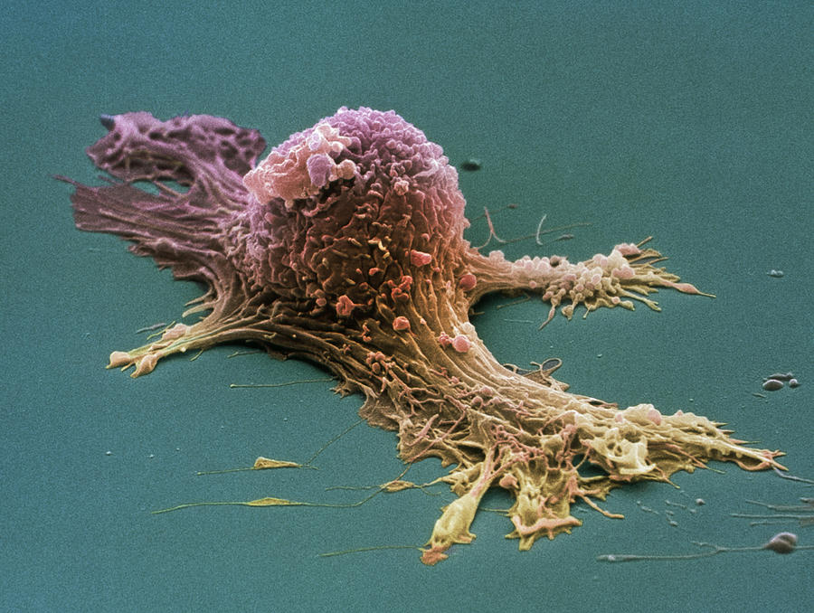 Ovarian Cancer Cell Sem Photograph By Steve Gschmeissner Fine Art America