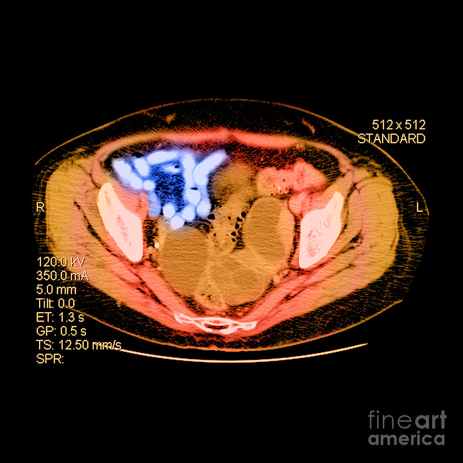 Ovarian Cancer #1 Photograph by Medical Body Scans