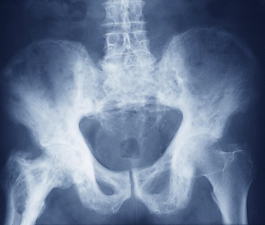 Pelvis In Paget S Disease X Ray Photograph By Zephyr Pixels