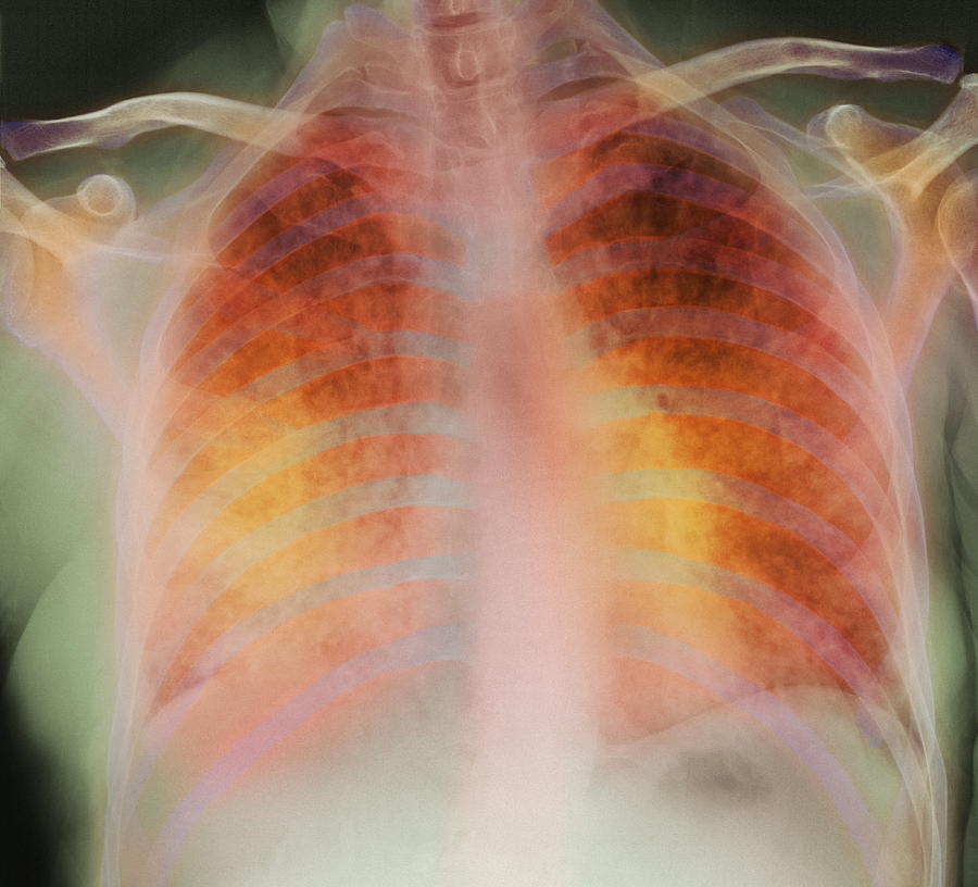 Pneumonia, X-ray #1 by