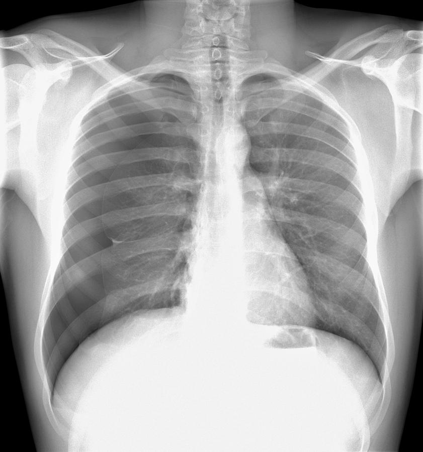 collapsed lung x ray