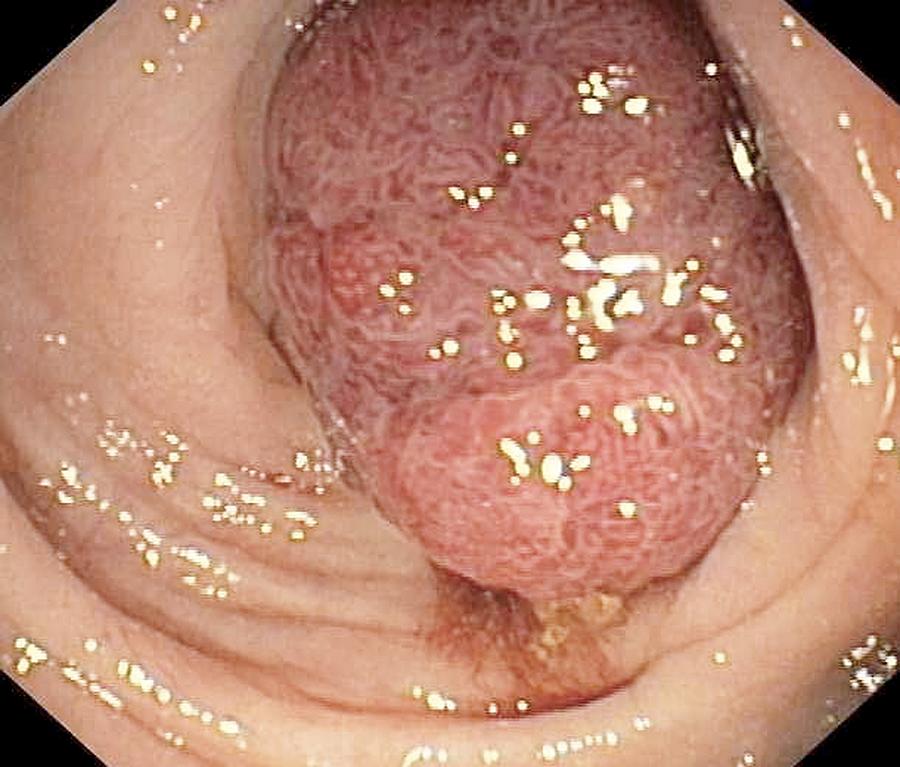 Ring Photograph - Premalignant Colonic Growth #1 by Gastrolab