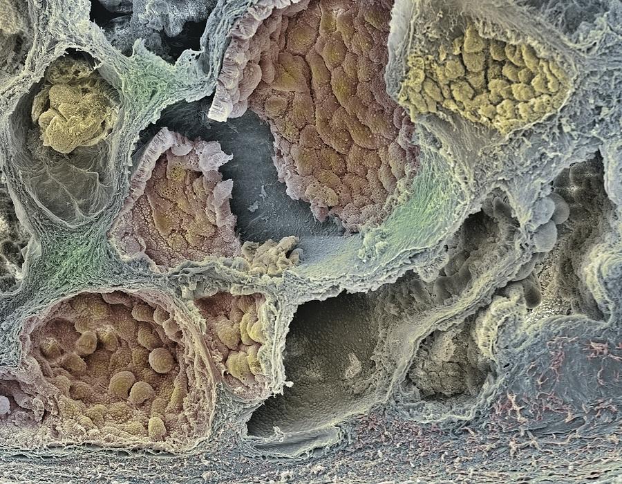 Prostate Cancer Sem Photograph By Steve Gschmeissner Fine Art America 8847