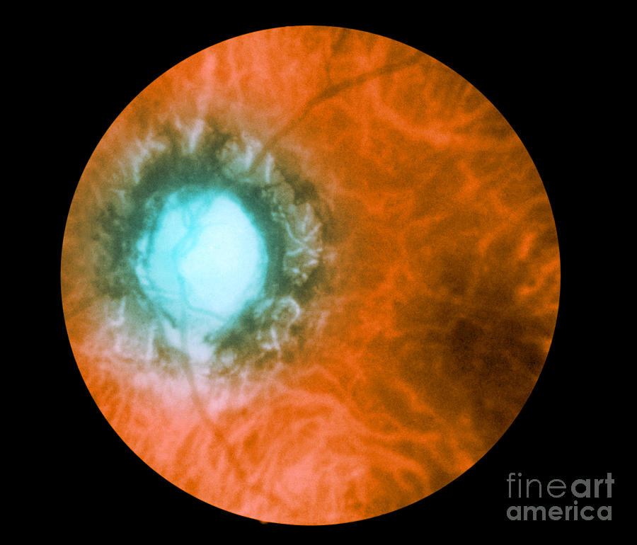 Retina Infected By Syphilis #1 Photograph by Science Source