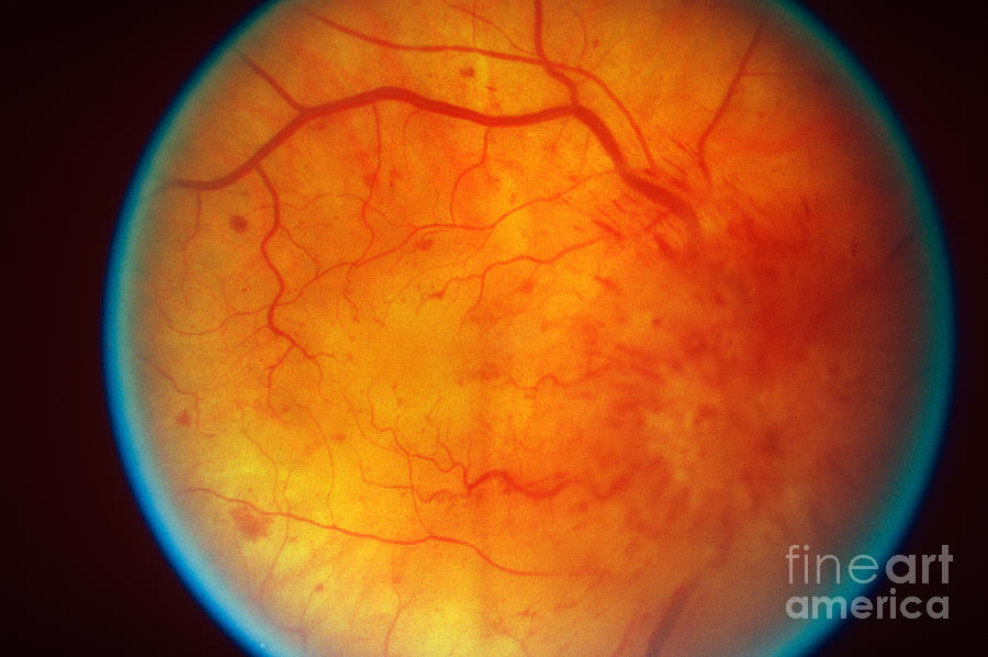 Retinal Papilledema #1 Photograph by Science Source