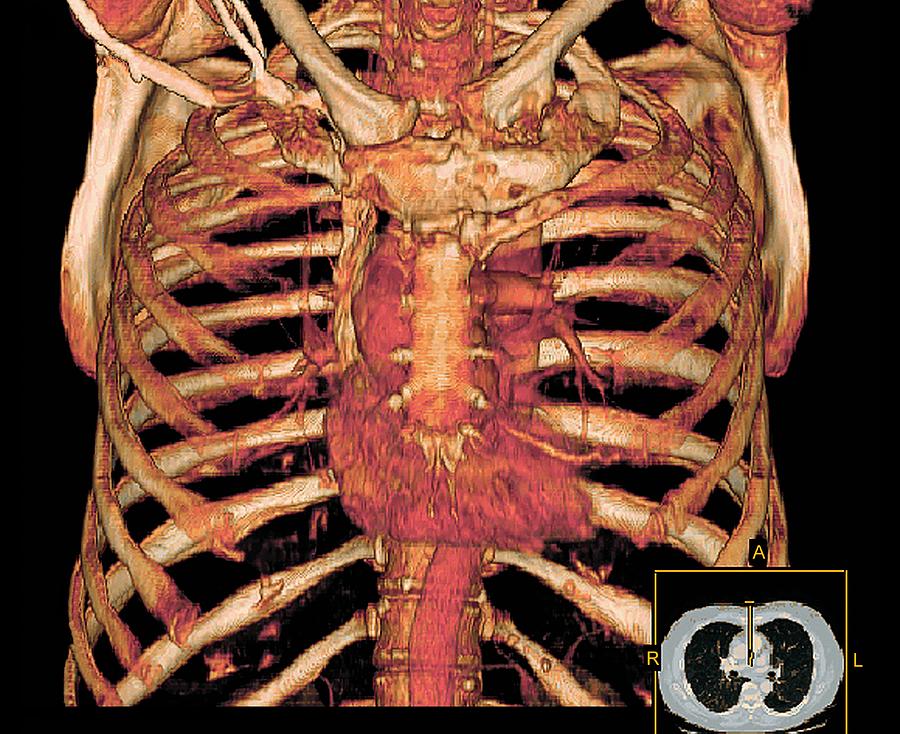 Ribcage And Blood Vessels 3d  Ct Scan  Photograph by Miriam 