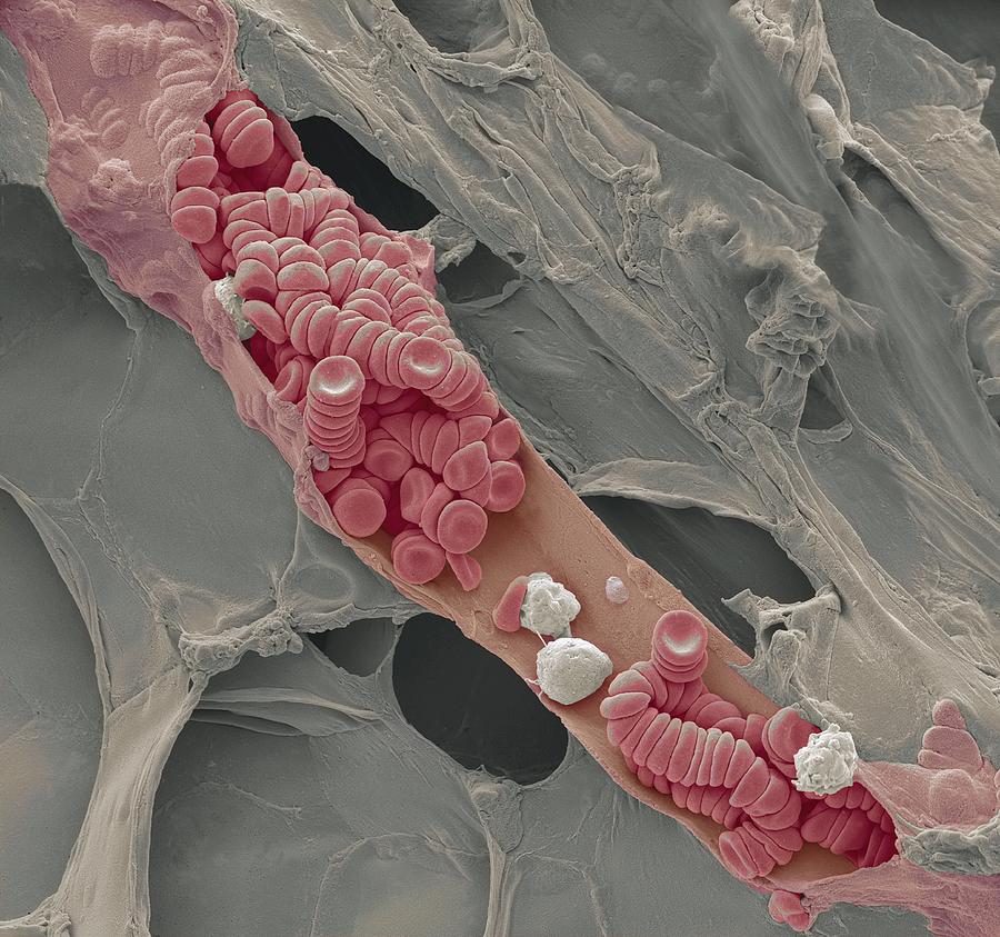 Electron Microscope Photograph - Ruptured Venule, Sem #1 by Steve Gschmeissner
