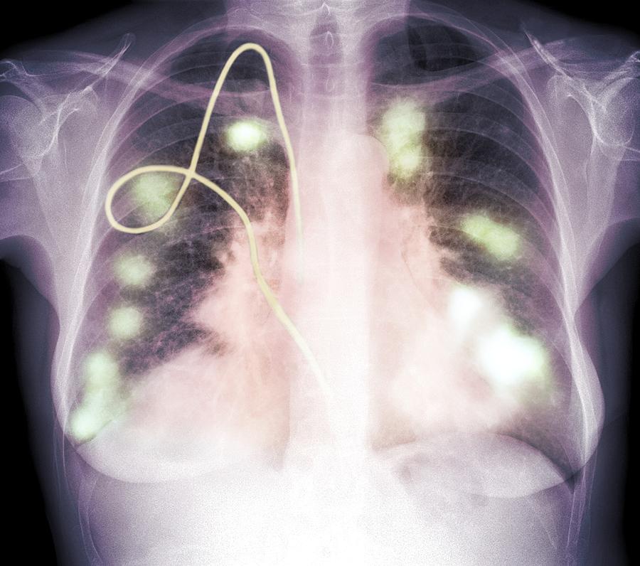 Secondary Lung Cancers, X-ray Photograph By Du Cane Medical Imaging Ltd