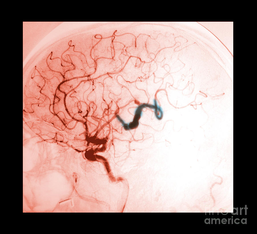 Serpentine Aneurysm #1 Photograph by Medical Body Scans