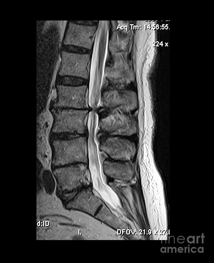Severe Spinal Stenosis #1 Photograph by Medical Body Scans