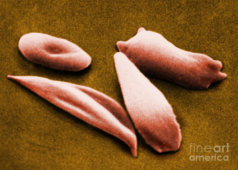 Sickle Red Blood Cells #1 Photograph by Omikron