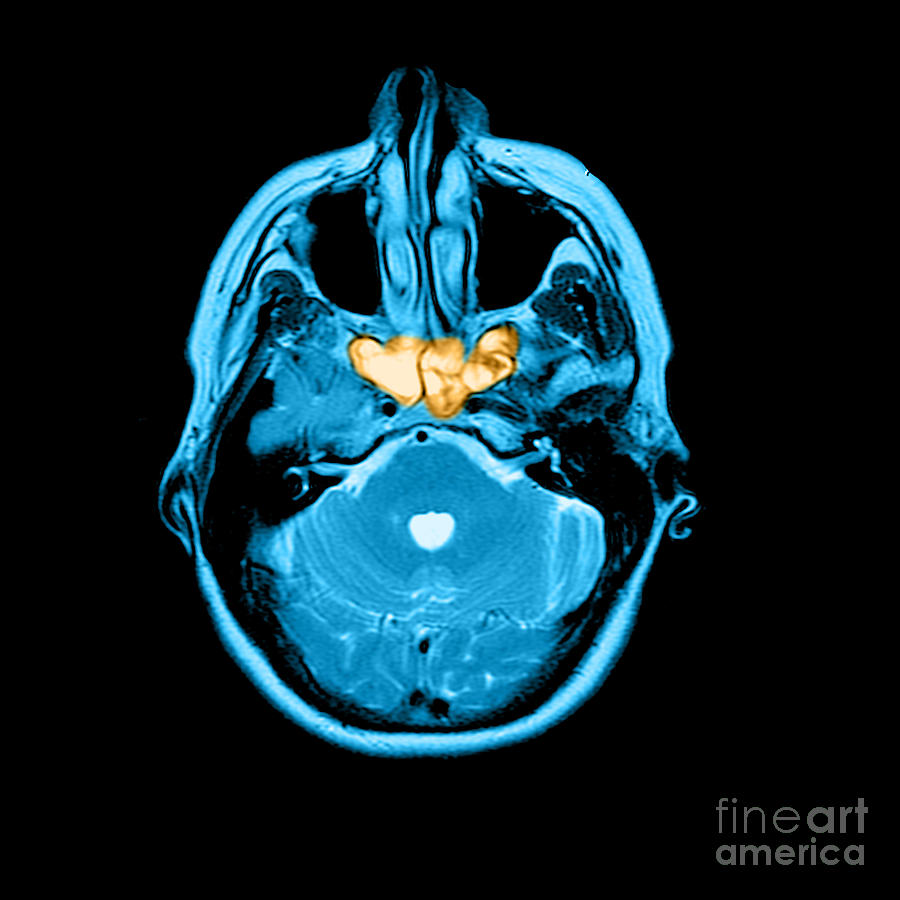 Sinusitis #1 Photograph by Medical Body Scans