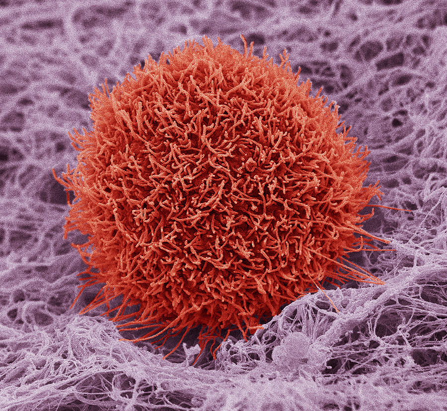 Squamous Cell Carcinoma Photograph - Skin Cancer Cell, Sem #1 by Steve Gschmeissner