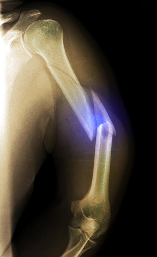 'splintered Arm Fracture, X-ray' Photograph by Du Cane Medical Imaging ...