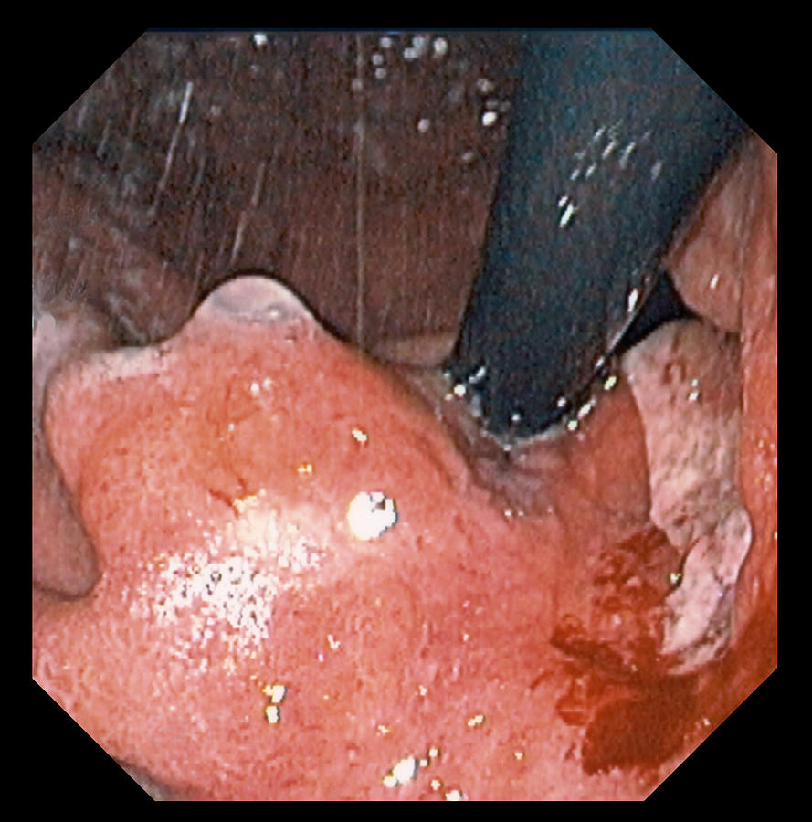 Gastric Photograph - Stomach Cancer #1 by David M. Martin, Md