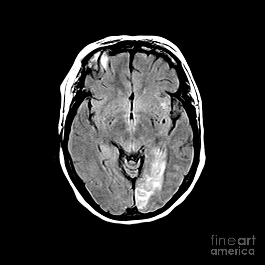 Stroke #1 Photograph by Medical Body Scans