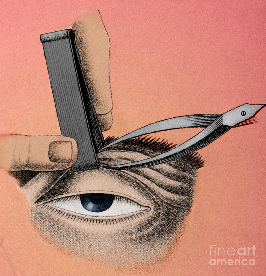 Surgery To Correct Lazy Eyelid, 1830 #1  by Photo Researchers
