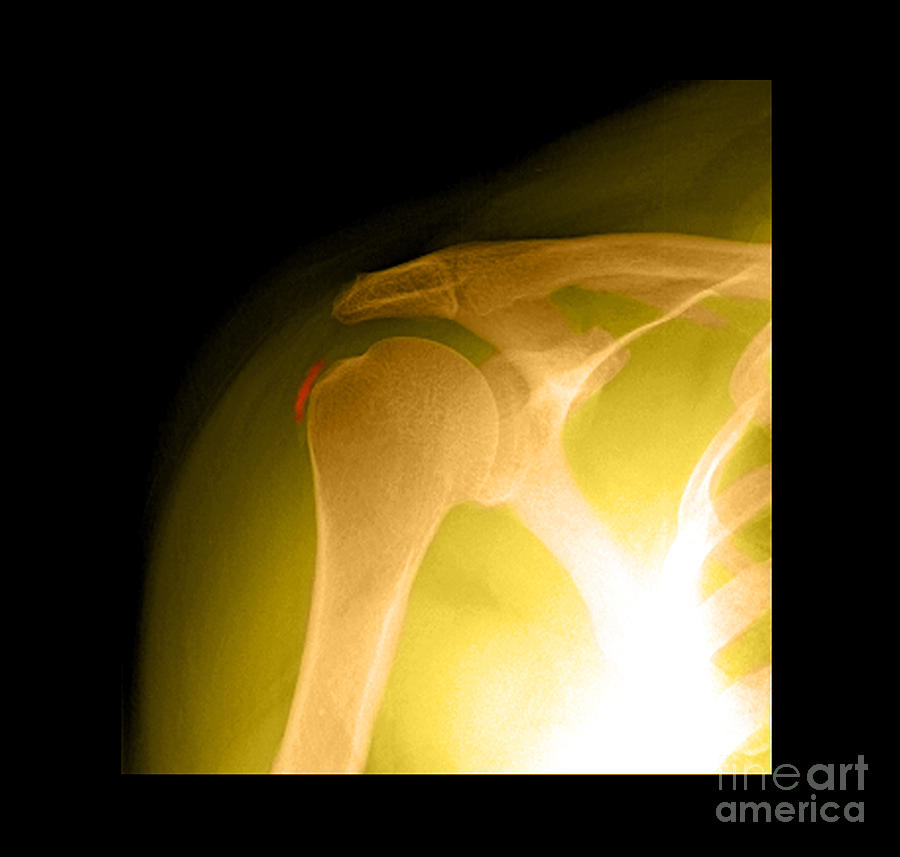 Tendinitis #1 Photograph by Medical Body Scans