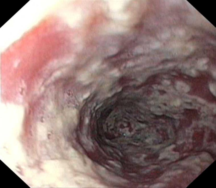 Endoscopy Photograph - Thrush In The Oesophagus #1 by Gastrolab