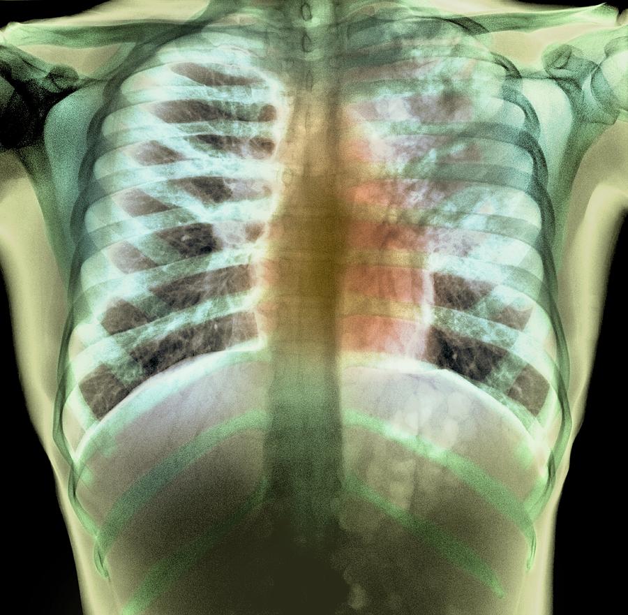 Tuberculosis X Ray Photograph By Du Cane Medical Imaging Ltd Pixels