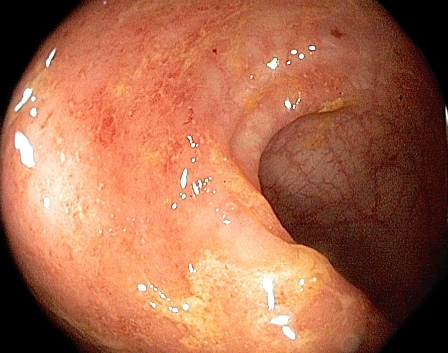 Endoscopy Photograph - Ulcerative Proctitis In The Rectum #1 by Gastrolab