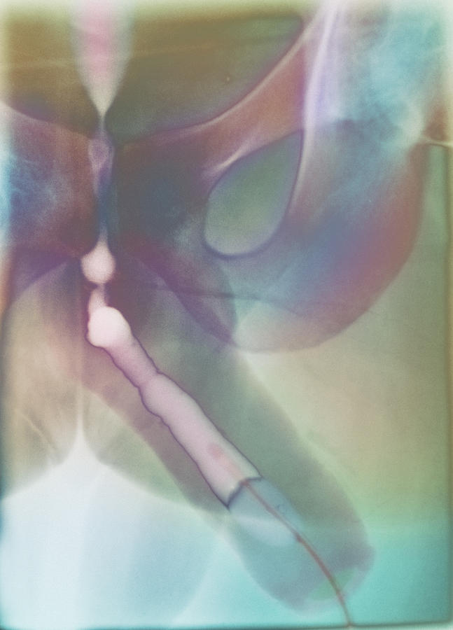 Infection Photograph - Urethritis, X-ray #1 by 