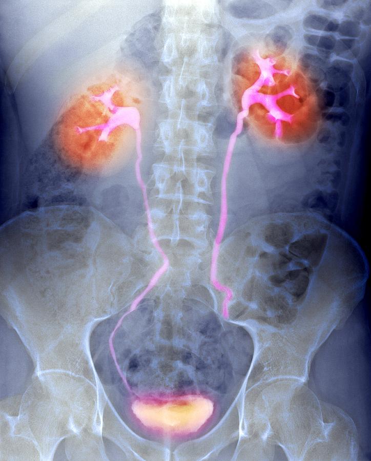 Urinary System X Ray Photograph By Du Cane Medical Imaging Ltd