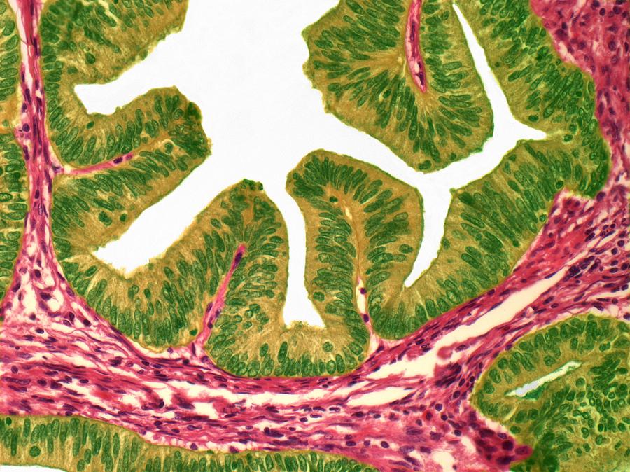 Uterine Cancer, Light Micrograph #1 Digital Art by Steve Gschmeissner