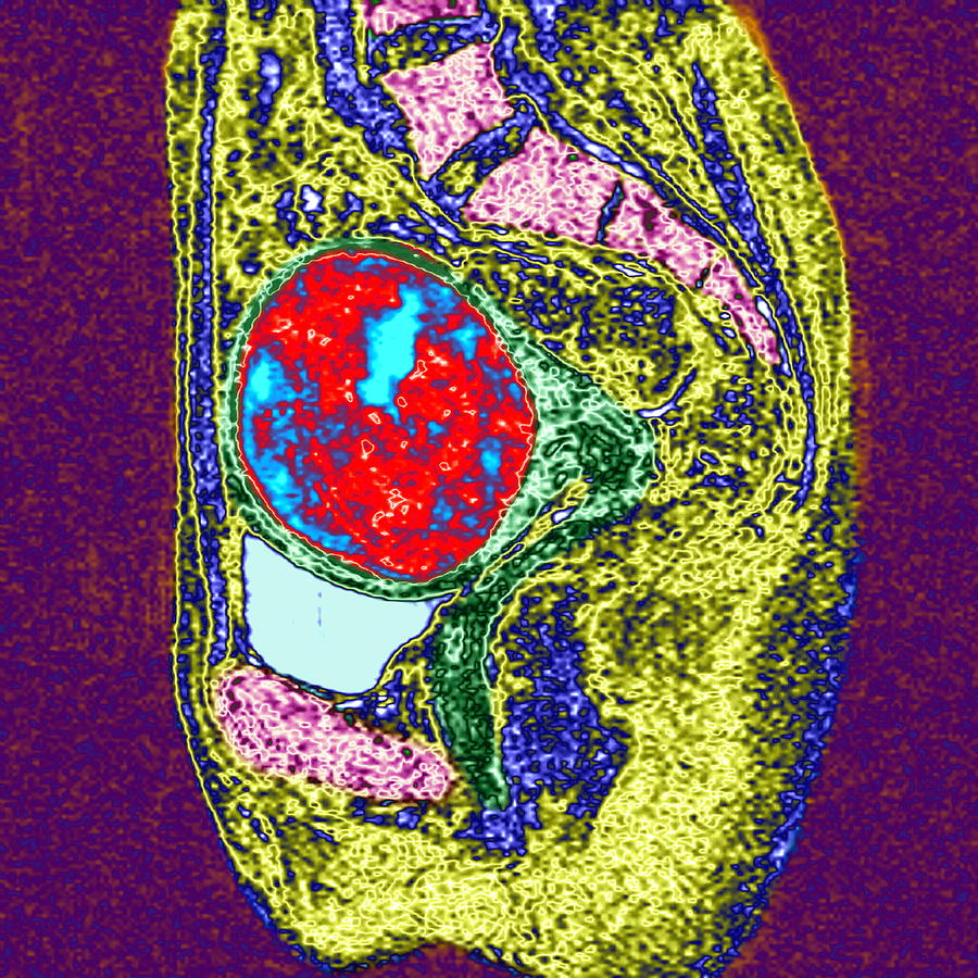 Uterine Fibroid Mri Scan Photograph By Du Cane Medical Imaging Ltd Pixels