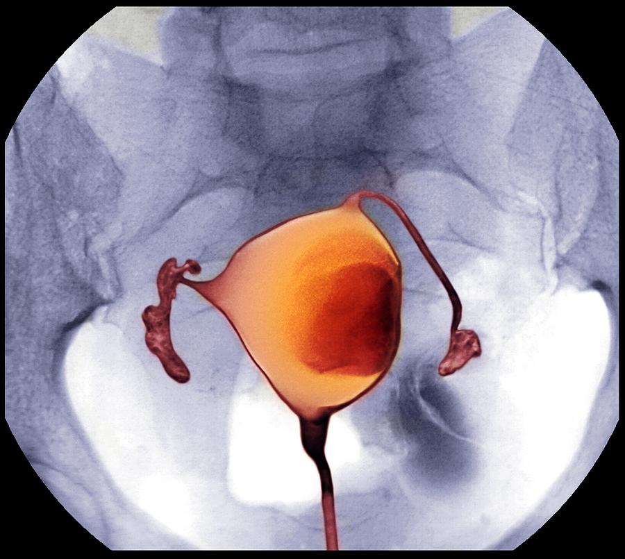 Uterine Fibroid X Ray Photograph By Du Cane Medical Imaging Ltd