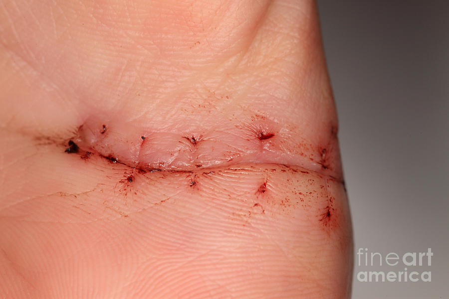 Science Photograph - Wound Healing Day 10 #1 by Ted Kinsman
