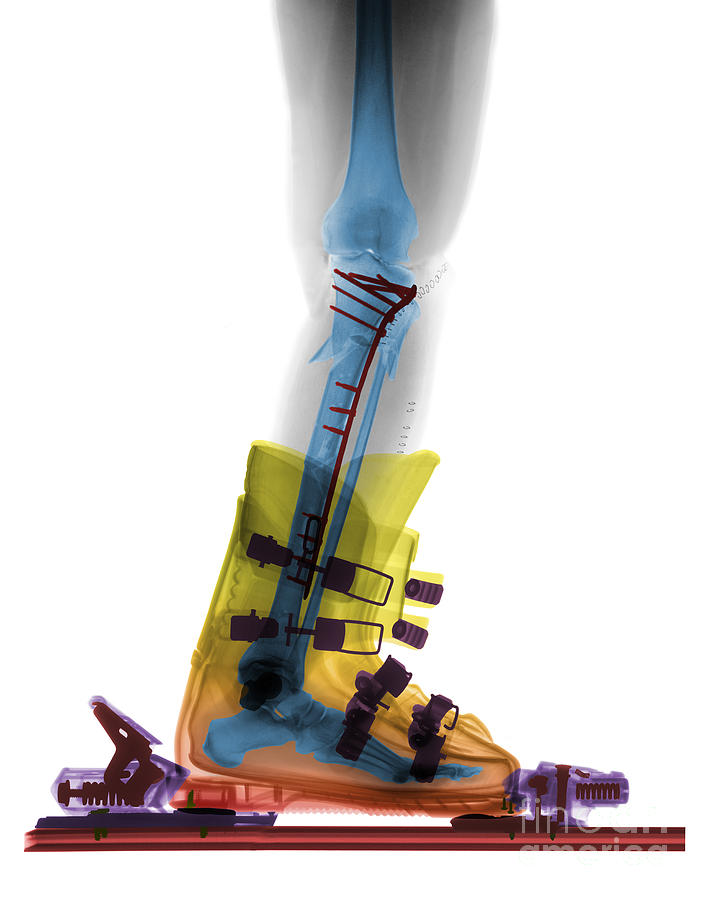 X-ray Of Broken Bones In Ski Boot #3 Photograph by Ted Kinsman