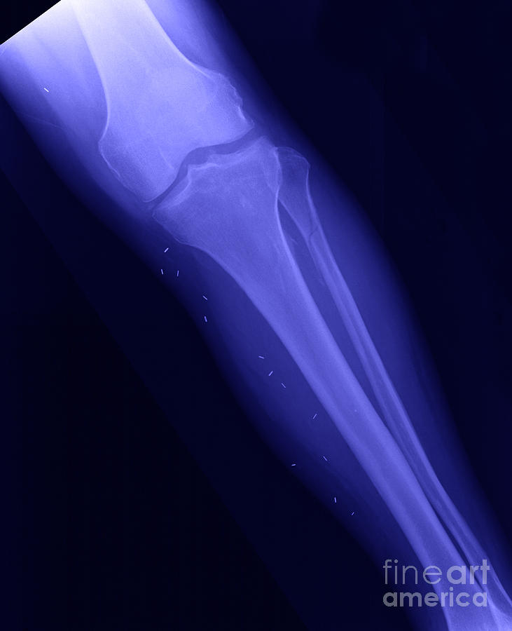 X-ray Of Broken Leg Photograph by Ted Kinsman - Fine Art America