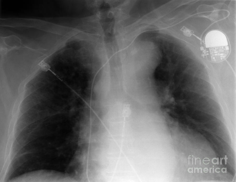 X-ray Of Implanted Defibulator #1 Photograph by Ted Kinsman