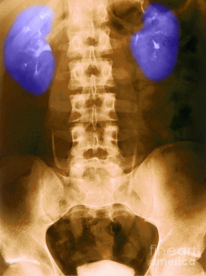 X-ray Of Normal Kidneys #1 Photograph by Science Source