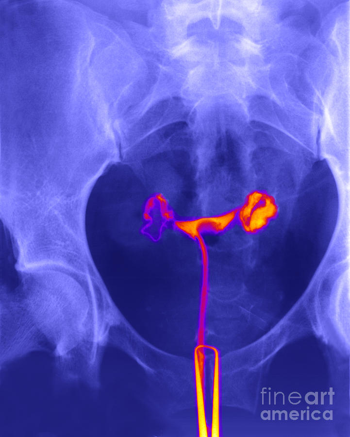 X-ray Of Ovaries #1 Photograph by Ted Kinsman