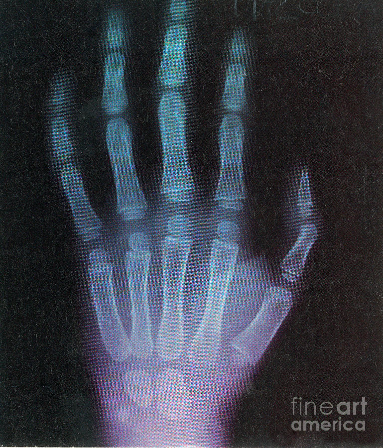 X-ray #1 Photograph by Photo Researchers