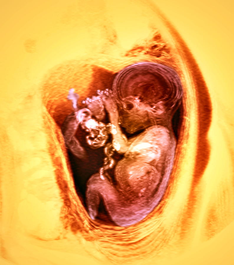 9 Month Foetus, Mri Scan Photograph by Du Cane Medical Imaging Ltd ...