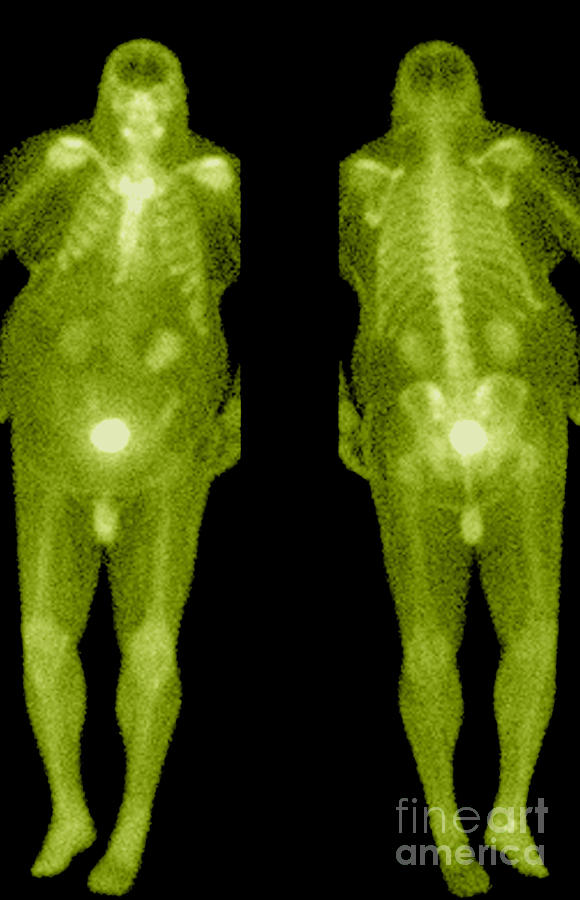 Bone Scan #10 Photograph by Medical Body Scans