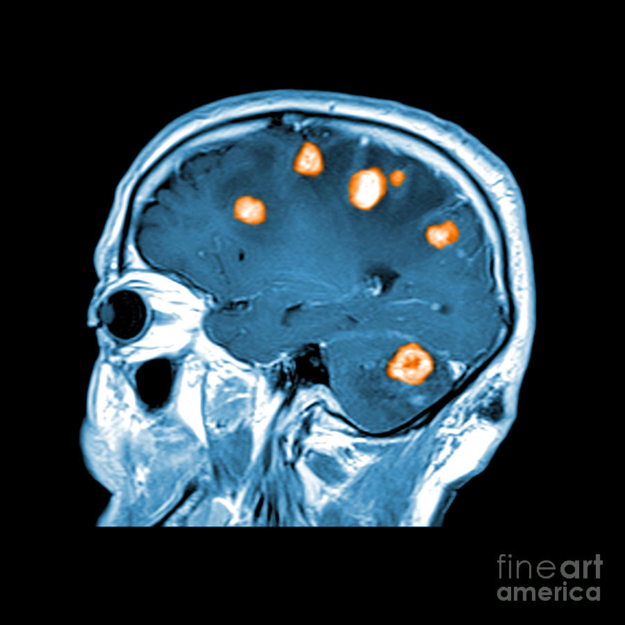 Brain Tumors #10 Photograph by Medical Body Scans