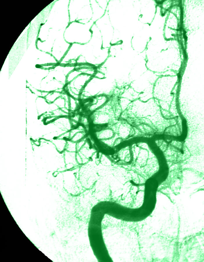 Cerebral Angiogram #10  by Medical Body Scans