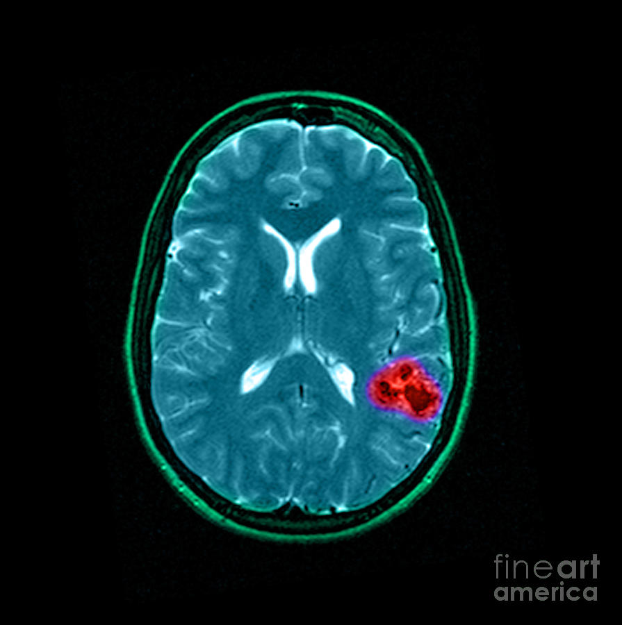 Abnormal Mri Brain Photograph - Mri Of Brain Avm #10 by Medical Body Scans