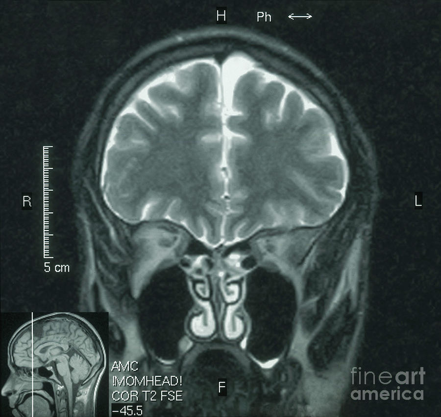 Mri Photograph - Mri Showing Arachnoid Cyst #10 by Science Source