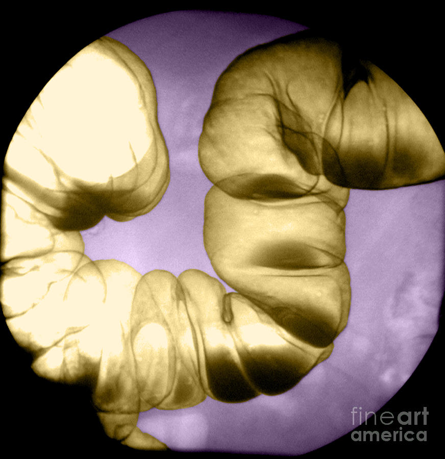 Normal Double Contrast Barium Enema #10 Photograph by Medical Body Scans