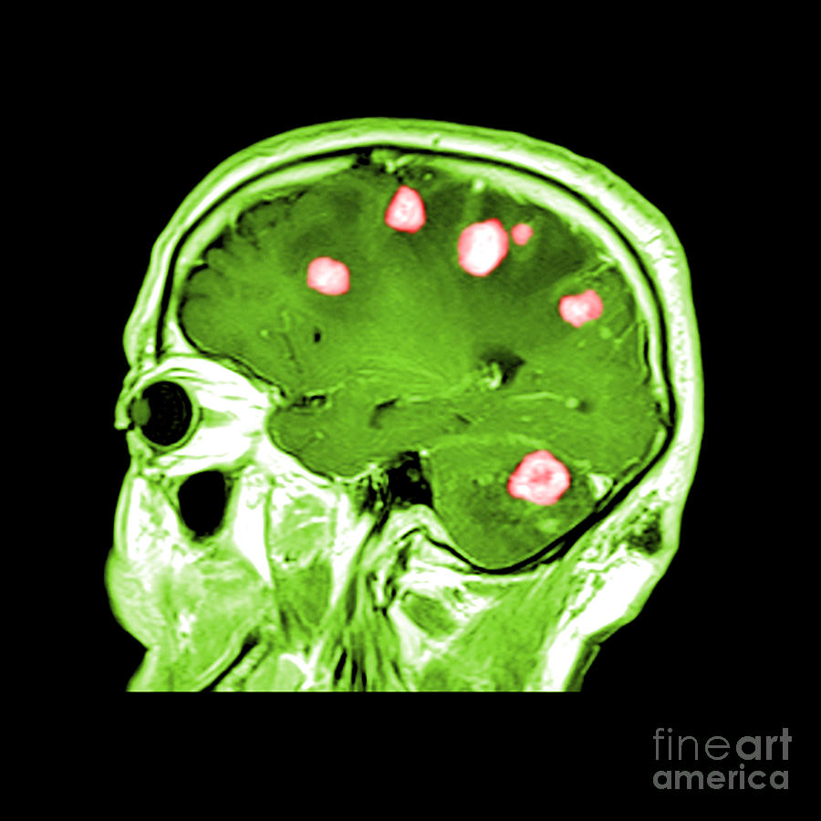 Brain Tumors #11 Photograph by Medical Body Scans