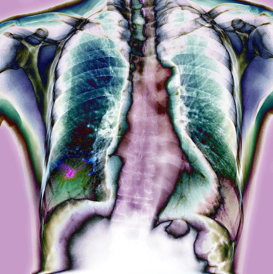 Lung Cancer, X-ray Photograph By Du Cane Medical Imaging Ltd - Fine Art ...