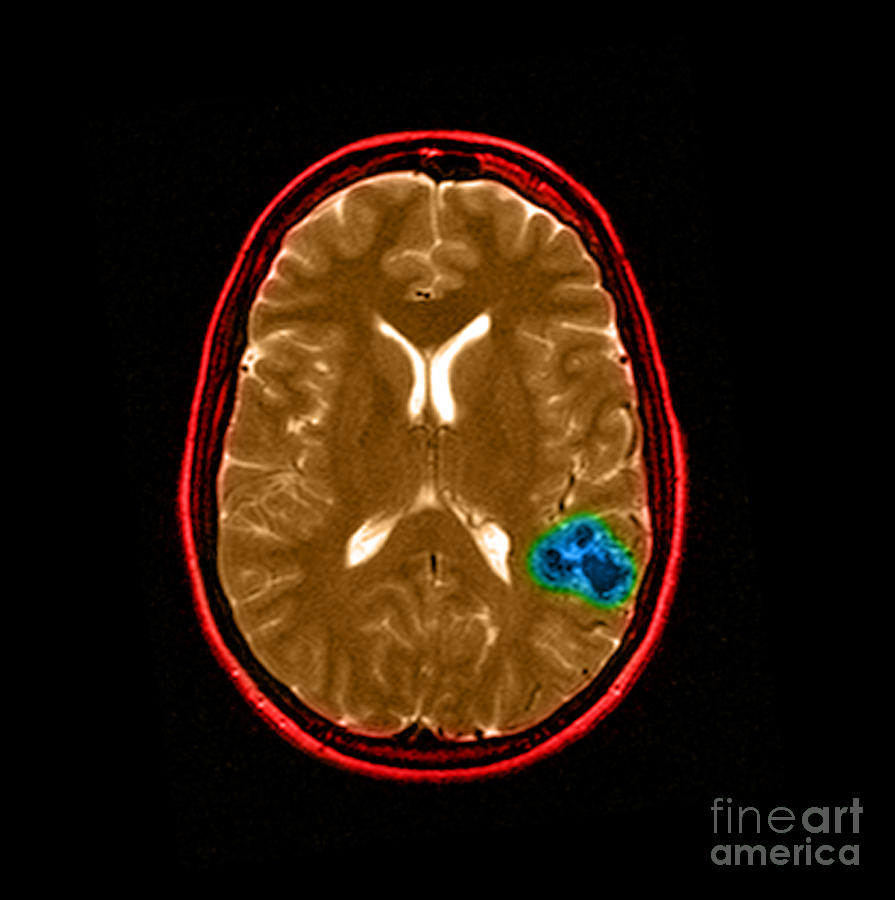 Mri Of Brain Avm #12 Photograph by Medical Body Scans