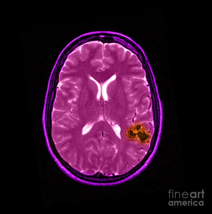 Mri Of Brain Avm #13 Photograph by Medical Body Scans
