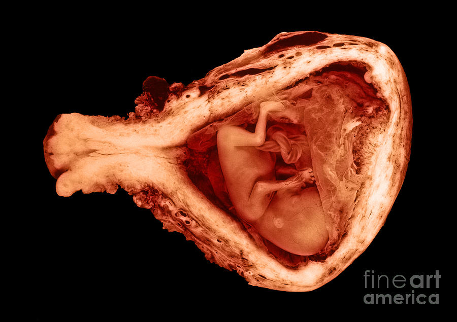 Fetal Photograph - 13 Week Old Human Fetus by Omikron